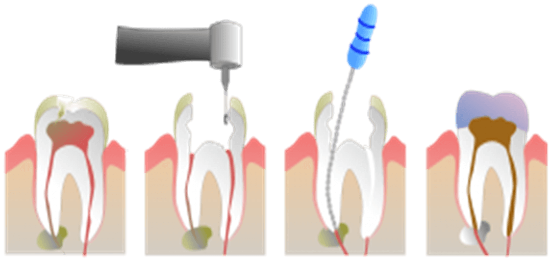 root canal treatment and procedure