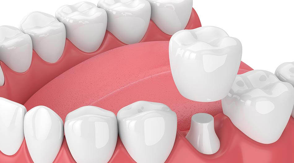 cerec crown cost without insurance