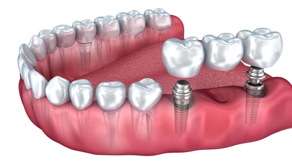 My Dentist at Morgan Creek - Dental Implant