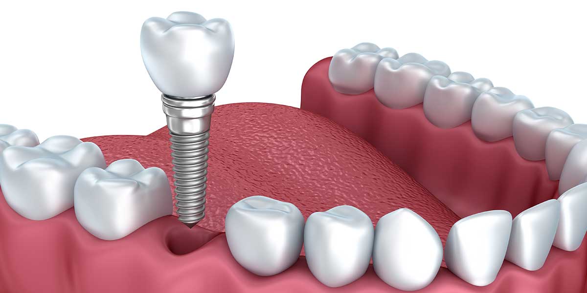 Single Dental Implant placed on lower jaw