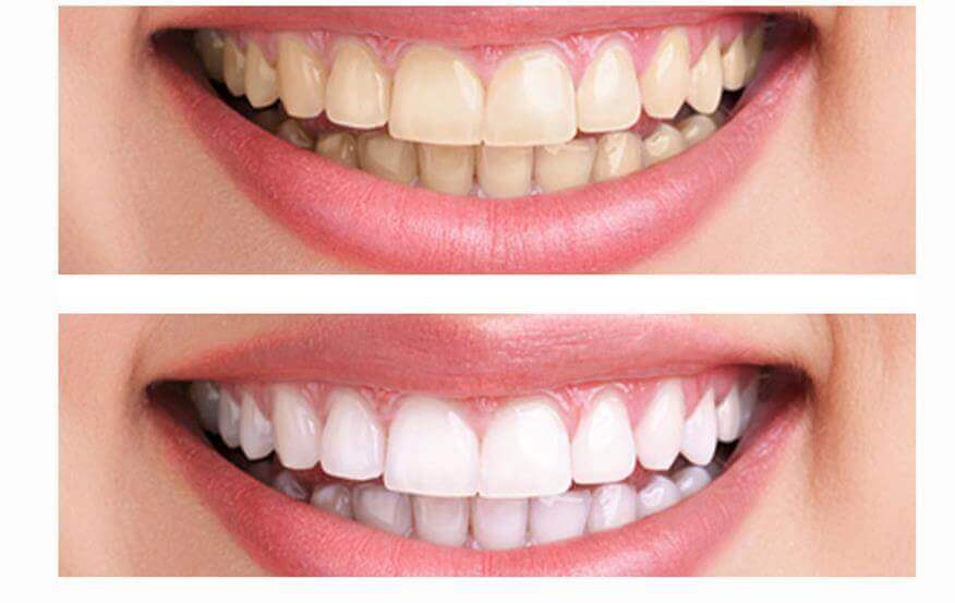 Whitening teeth Best Teeth