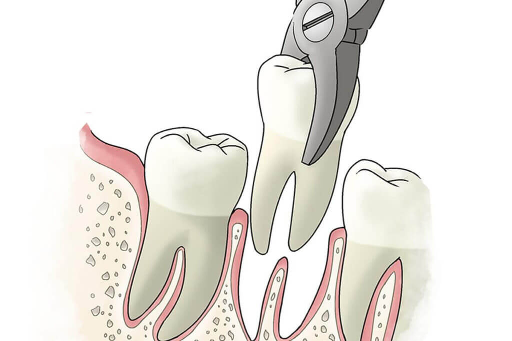 A tooth extraction 