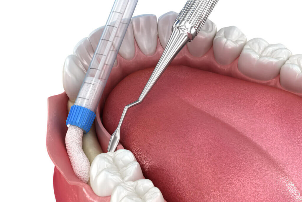 computer generated image of a bone graft procedure