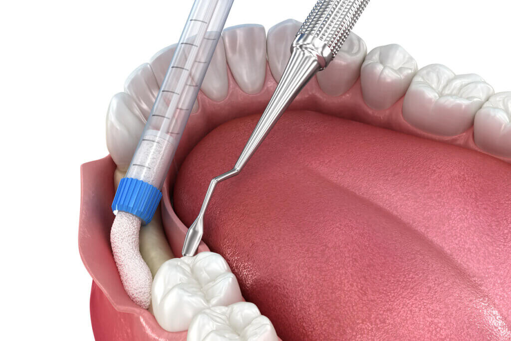 deteriorated jaw due to bone loss undergoing bone grafting