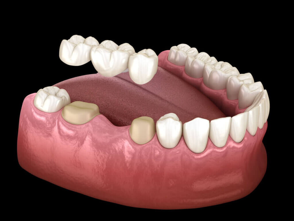 dental bridge