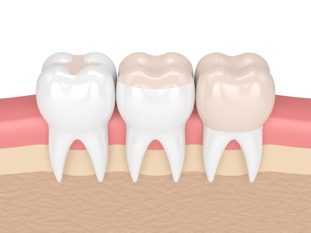 digital image of dental filling and dental crown
