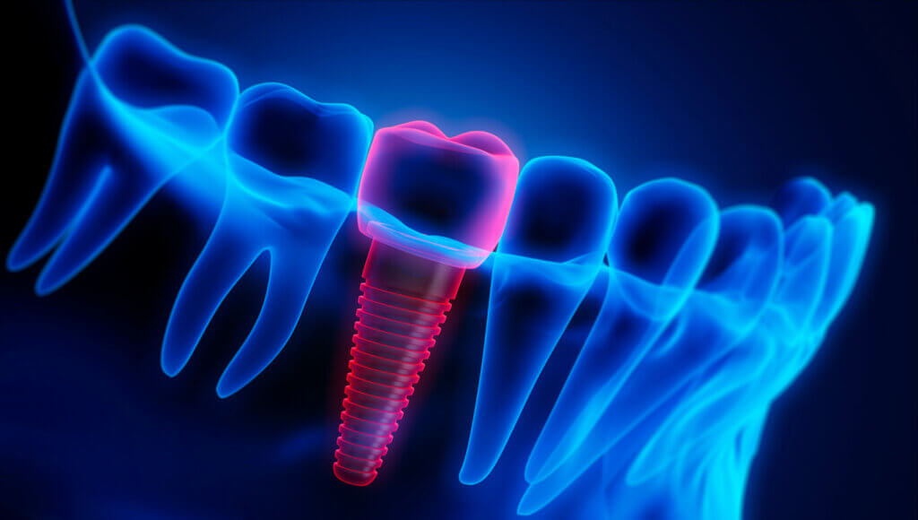 digital image of a jaw that includes a dental implant that is coloured in red