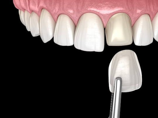 A graphic image showing how dental veneers are placed over natural teeth.