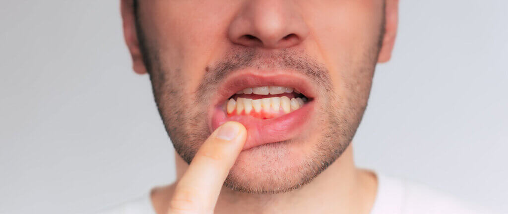 Close up image of gum inflammation. Cropped shot of a young man showing red bleeding gums isolated on a gray background. Dentistry, dental care