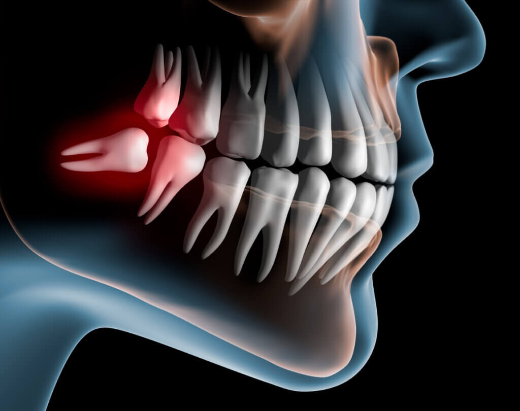 Reclining wisdom tooth in the lower jaw in front of dark background - 3D Illustration
