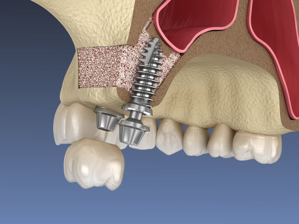 computer generated image of a sinus lift operation and a dental implant