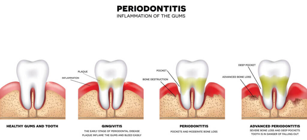 the stages of gum disease
