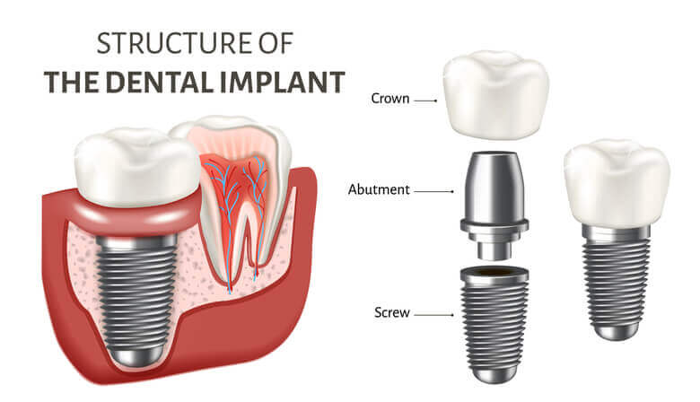 A diagram showing the structure of a dental implant and how it fuses into jawbone.