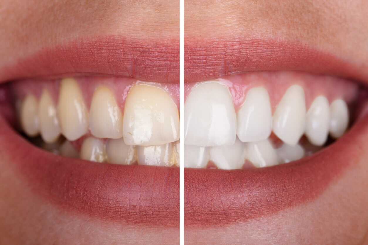Teeth whitening before and after photo