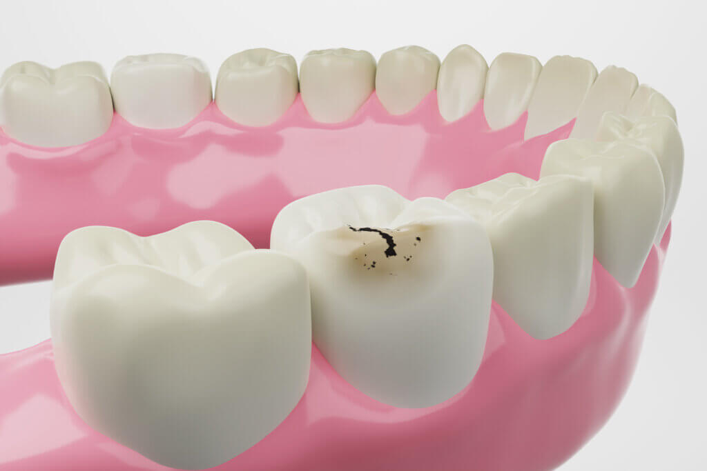 ooth decay / cavity isolated white background 3D rendering.